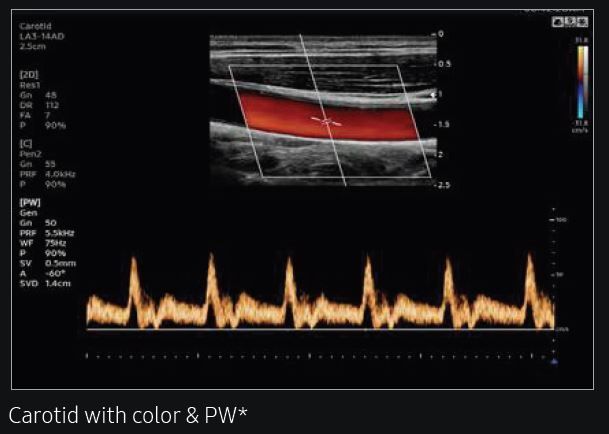 Nyaki erek (Carotis color Doppler) ultrahang vizsgálat, doppler, artéria, 